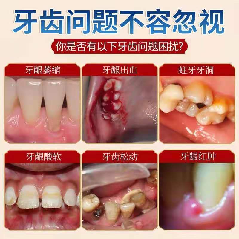 中药感牙膏牙齿松动固齿清火护龈牙膏牙龈萎缩肿痛出血|牙龈牙膏+美白牙粉