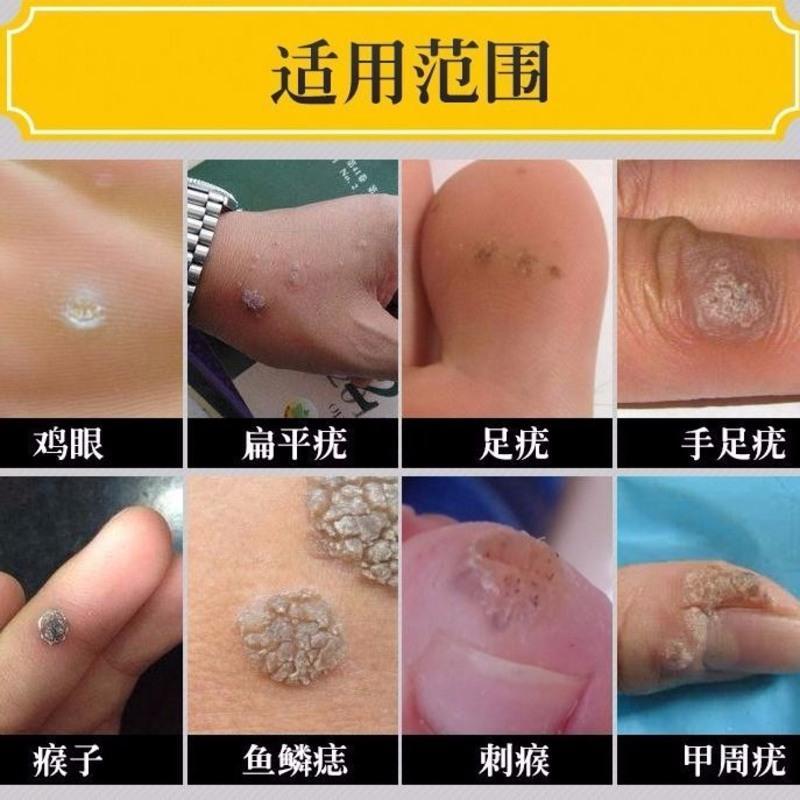 瘊子祛鸡眼膏祛跖疣刺瘊去除疣灵丝疣寻常疣去除瘊子鸡眼