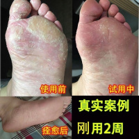 【优选】真菌克星喷剂止痒脱皮膏除脚臭水泡型烂脚丫灰指甲手足藓