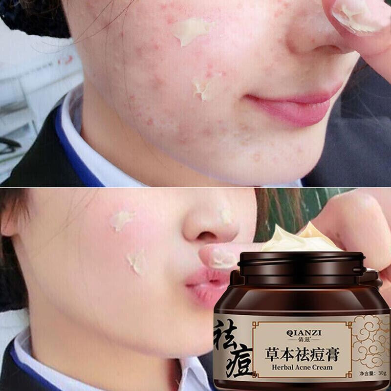 倩滋草本修复祛痘膏男女祛除痘印痘坑粉刺痘疤凹洞30g默认参数