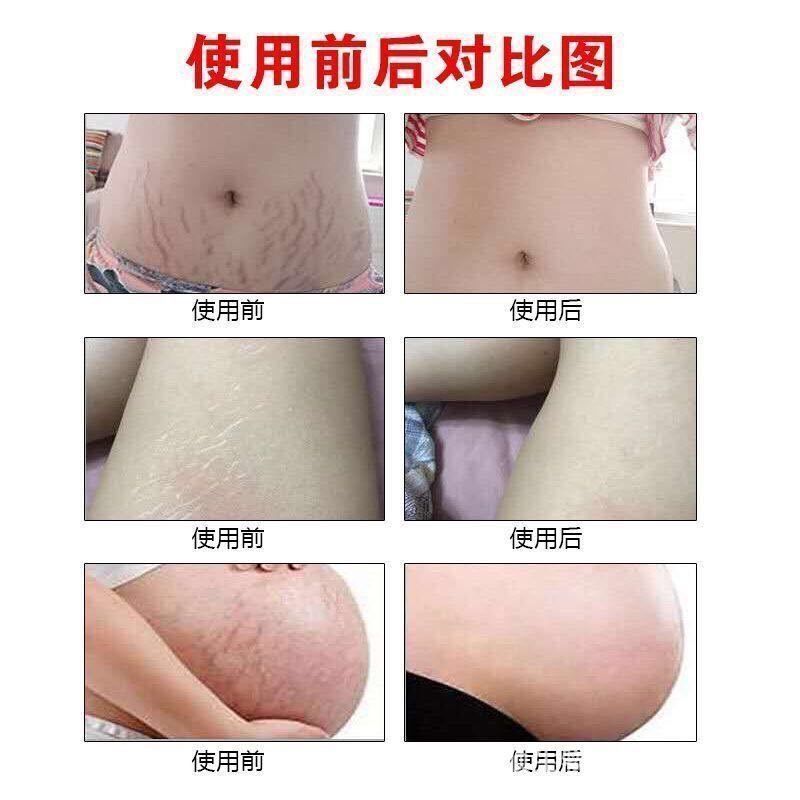 去妊娠纹产后修复霜紧致肚皮产前孕妇用品肥胖纹孕期预防专用 肌肤修护霜