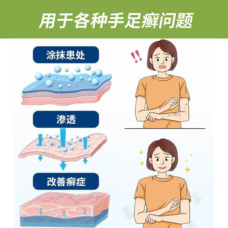 周郎中手癣膏脱皮干裂真菌感染脚痒水泡型手足癣专用皮肤外用止痒膏