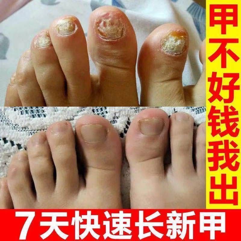 液增厚灰甲亮甲去除灰指甲专用脱甲油抑菌液一瓶[10ml]体验装>800_800