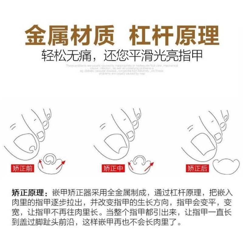 (专业解决指甲扎肉里)甲沟炎矫正器嵌甲矫正器修脚工具指甲矫正 嵌甲矫正器1个(无铁盒装)