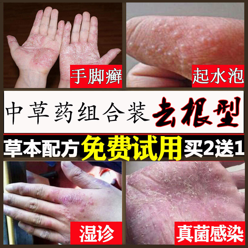 顽固手癣膏手足癣真菌感染脱皮干裂水泡湿疹止痒鹅掌风专用参数