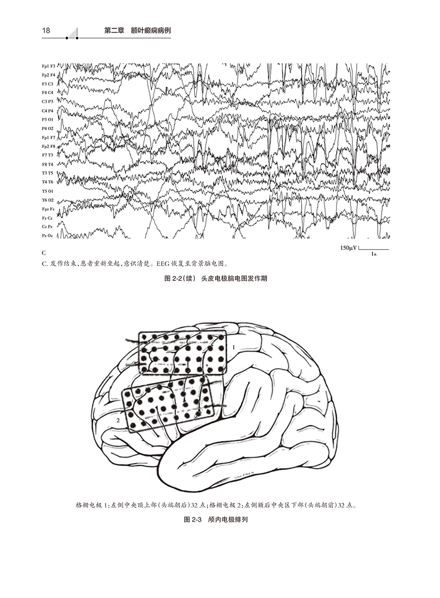 [醉染正版]癫痫术前评估脑电图图谱 医学书籍书 人民卫生出版社 王玉平高清大图