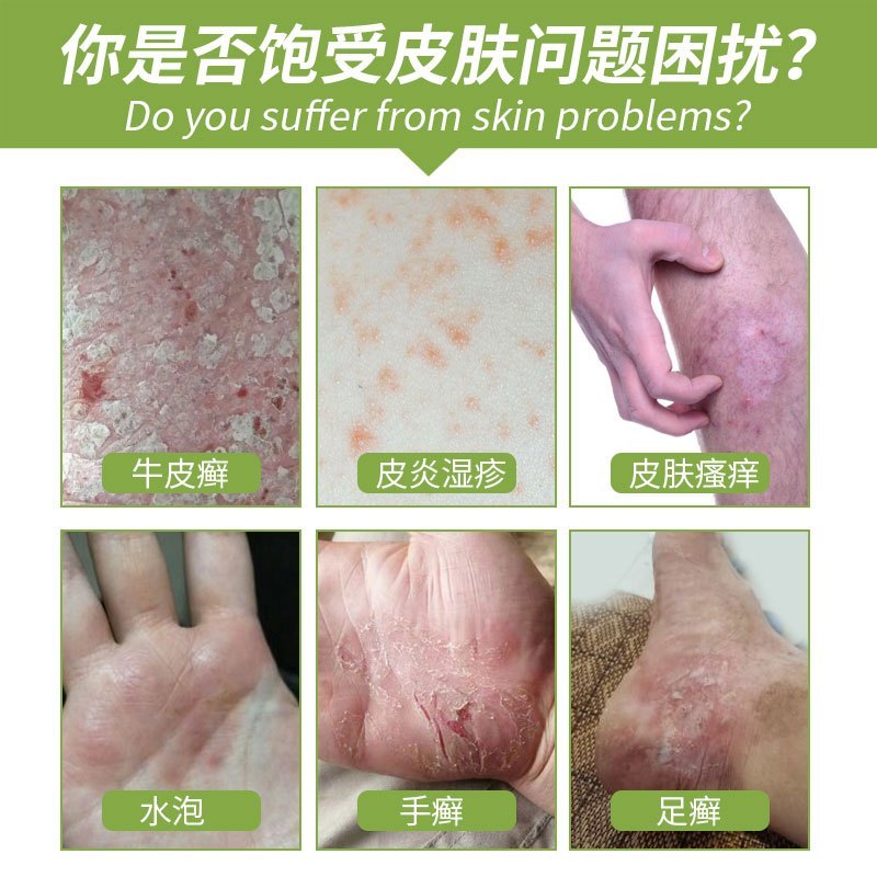 周郎中手癣膏脱皮干裂真菌感染脚痒水泡型手足癣专用皮肤外用止痒膏