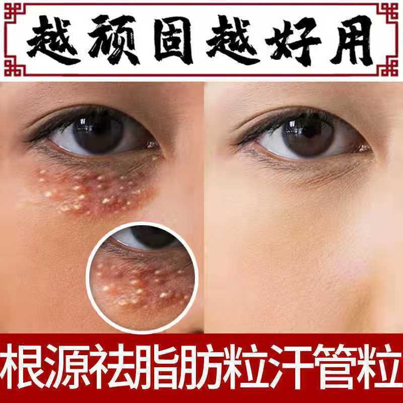 粒油脂粒汗管粒眼霜消除眼部脂肪粒去除神器一盒装[优惠价]800_800