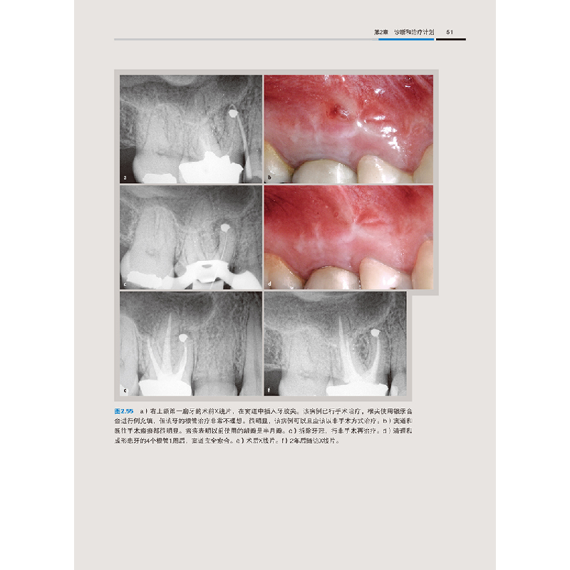 醉染图书牙髓显微外科治疗技术9787559118578高清大图