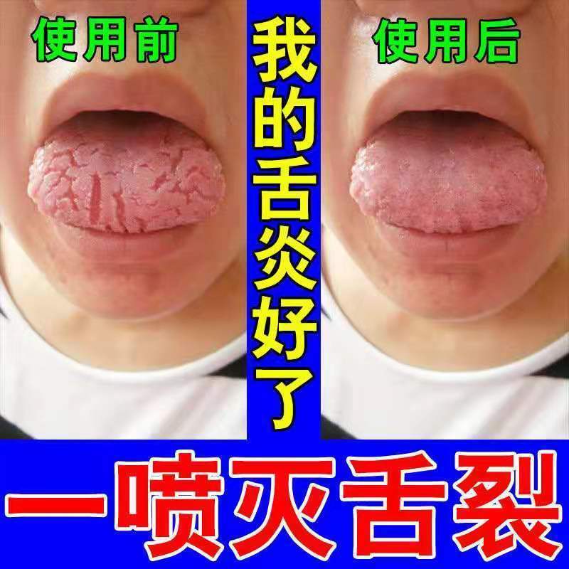 8秒闭合舌裂舌头开裂干裂舌头上火起泡舌苔厚舌头烂舌炎喷剂一盒体验