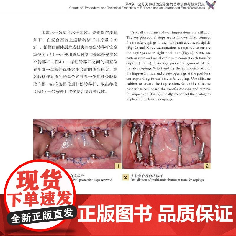 数字化种植导板与全瓷修复中的医技实践 数字化技术在口腔种植和修复领域应用 种植导板 全瓷修复材料 辽宁科学技术