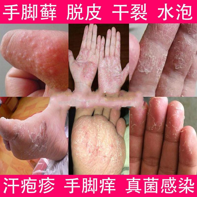 誉芙美护足霜手痒水泡脱皮干裂手气手足癬脚癬鹅掌风手癣膏脱皮真菌感染开干裂水泡鹅掌风手脚足藓皮肤膏手脚 价格图片品牌报价 苏宁易购沐空美妆护肤专营店