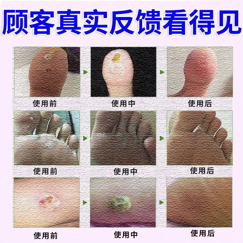 [无痛掉]鸡眼膏鸡眼贴去垠脚趾手指长鸡眼跖疣顽固反复鸡眼专用 鸡眼