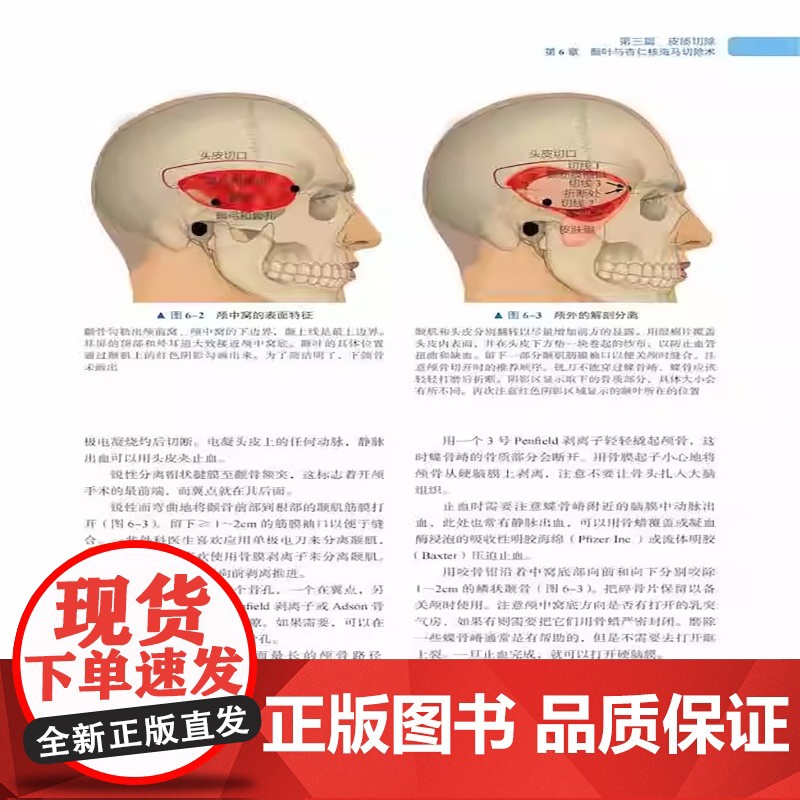 [央视网]癫痫外科手术技术 原书第2版 栾国明 周建主译 附赠视频 癫痫常用手术技术颅内电极脑电监测诊疗ZK DF高清大图