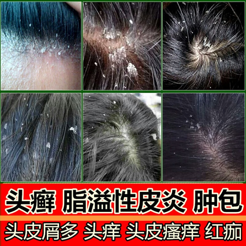 毛囊炎洗发水奋达洗剂头皮癣去头皮屑毛囊炎洗发水头癣脂溢性皮炎专用