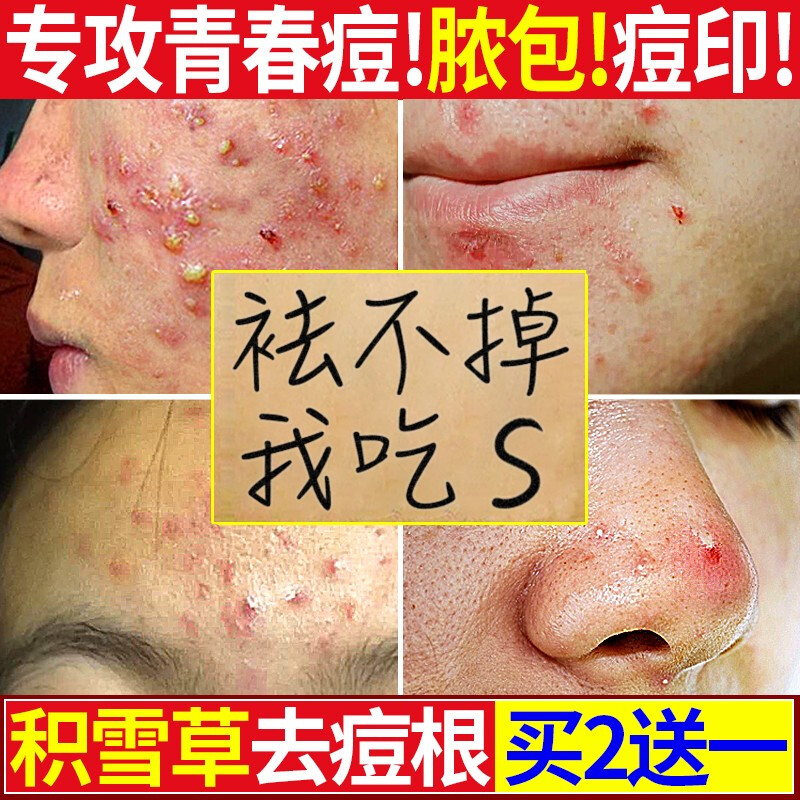 康雪面霜草本祛痘 祛痘膏去痘印闭口痘痘肌抗痘凝胶男女士青春痘粉刺学生芦荟胶痘坑凹洞修复积雪草产品 价格图片品牌报价 苏宁易购淘易乐化妆品旗舰店