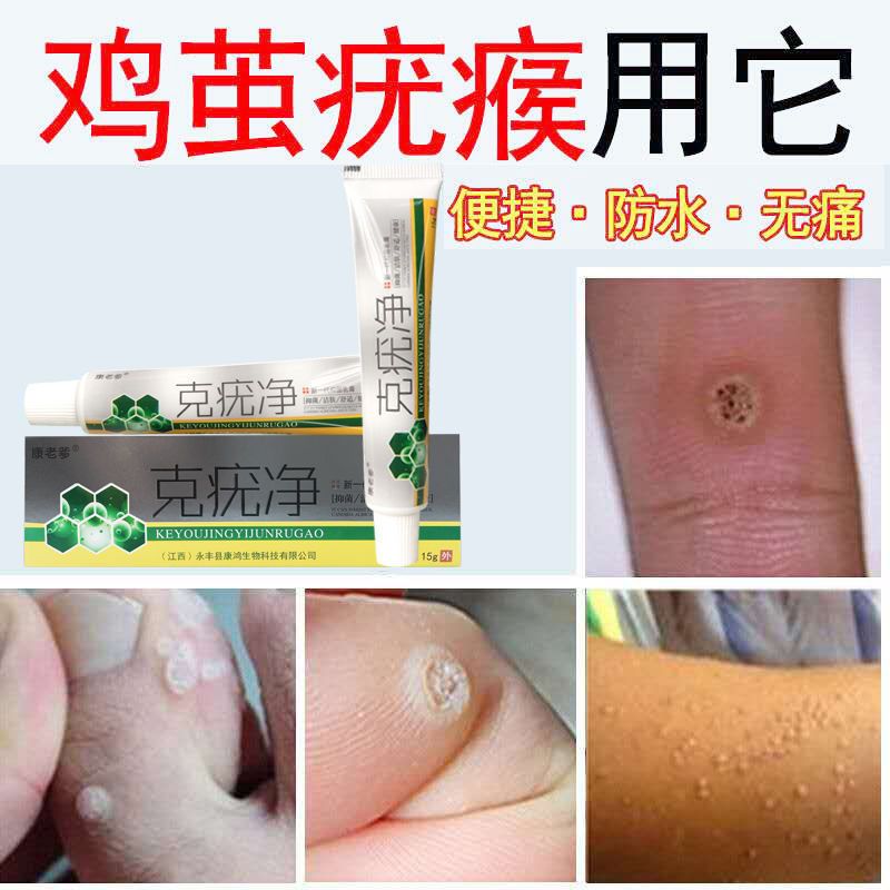 扁平疣特效康老爹克疣净抑菌乳膏鸡眼膏瘊子特效一抹见效克优净1瓶买