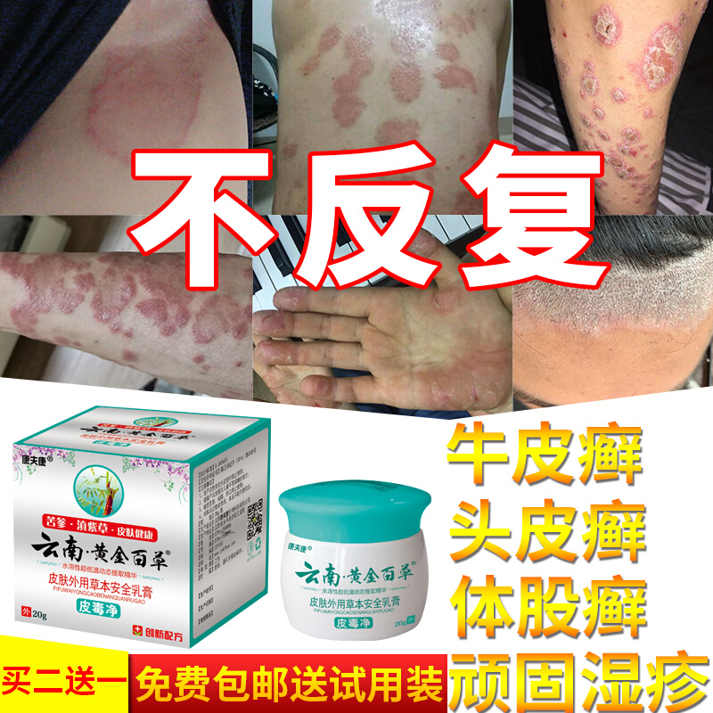 本维莫德乳膏鲜银屑手足股藓湿s疹止痒去根断根皮肤专用外用真菌感染y