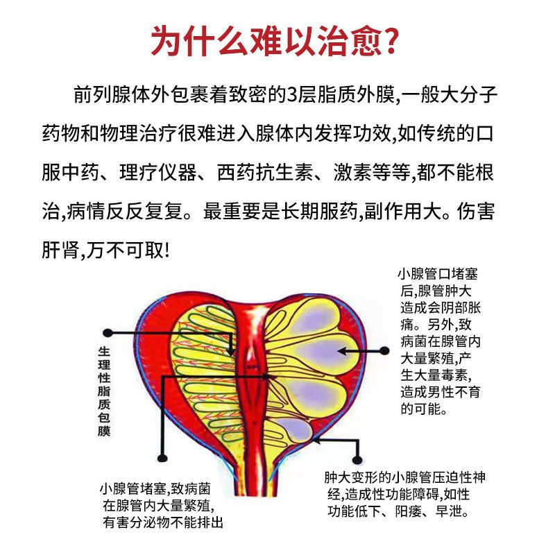 一盒体验装(共4贴) 前列腺贴尿频尿急增生肥大潮湿钙化尿不尽尿分叉尿等待前列腺炎贴