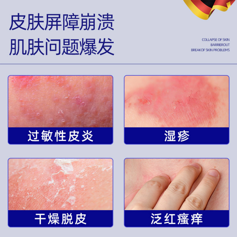 沃朗森湿疹止痒去瘙根皮肤干潮湿外用私处痒水泡顽固皮炎肛周门1788