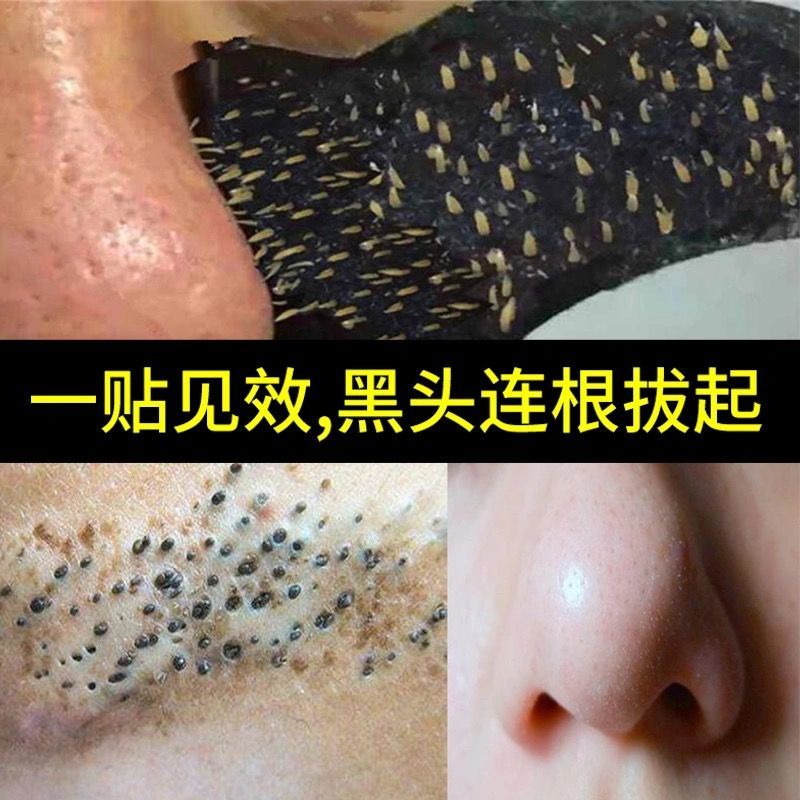 去黑头鼻贴粉刺神器鼻子鼻头贴吸黑头收缩毛孔男女通用螨虫黑头贴深层