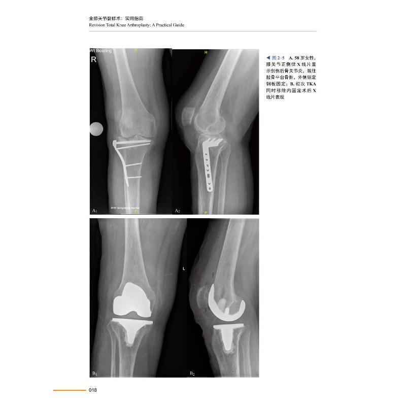 [醉染正版]全膝关节翻修术 实用指南 (英)霍萨姆·E.马塔尔 等 著 左建林,吕佳音 译 家庭保健 生活 中国科学技术