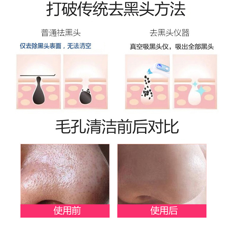 金稻(kingdom)吸黑头仪 KD802 祛黑头粉刺仪器 毛孔清洁器 电动吸粉刺机 洁面仪高清大图