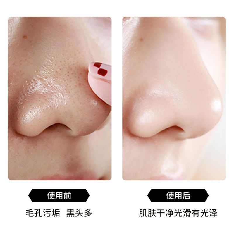 日本小气泡寡肽面膜补水控油祛痘收缩毛孔去黑头粉刺学生党神器不推荐