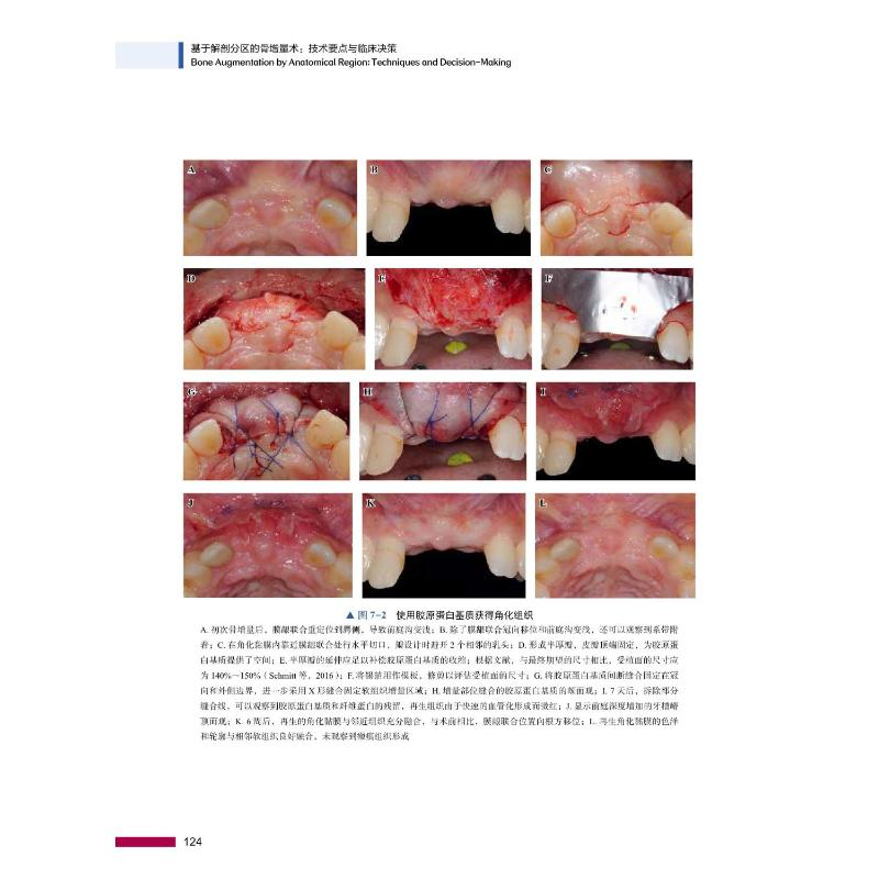 正版新书】基于解剖分区的骨增量术 技术要点与临床决策(以)兹维·
