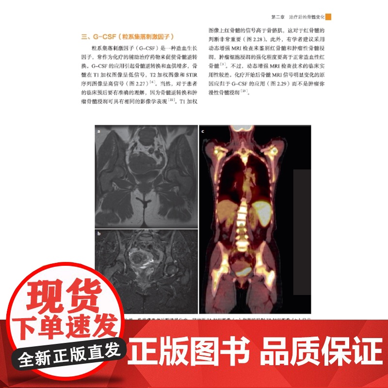 小儿与成人骨髓MRI诊断图谱 正常表现、变异和弥漫性病变 图文结合医学专著 广东科技出版社店发货高清大图
