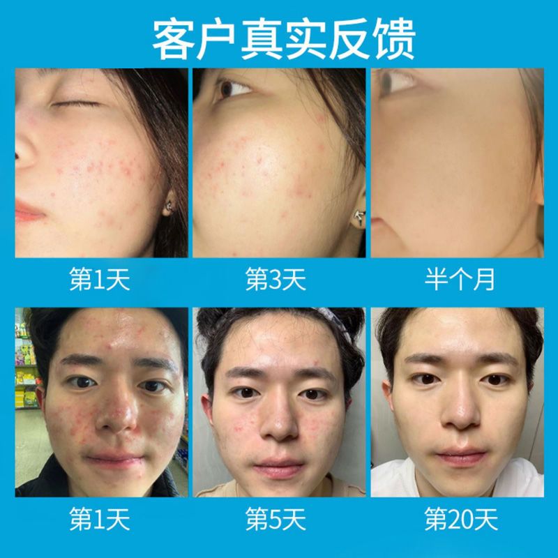 祛痘茶排毒去火痘痘茶下火茶内分泌失调茶治青春痘上火去熬夜必喝 一袋30小包体验装