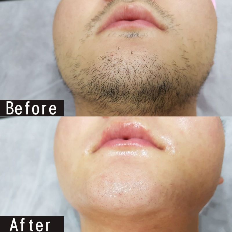 脱毛膏快速脱胡须去胡子脱腋下手毛腿毛胡须胸毛肛毛男女全身通用 qmg