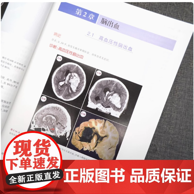 临床神经影像学病例精粹 神经系统疾病影像学 癫痫 脑血管病 自身免疫疾病 脱髓鞘性疾病等 神经病学领域 张静 陈薇主译