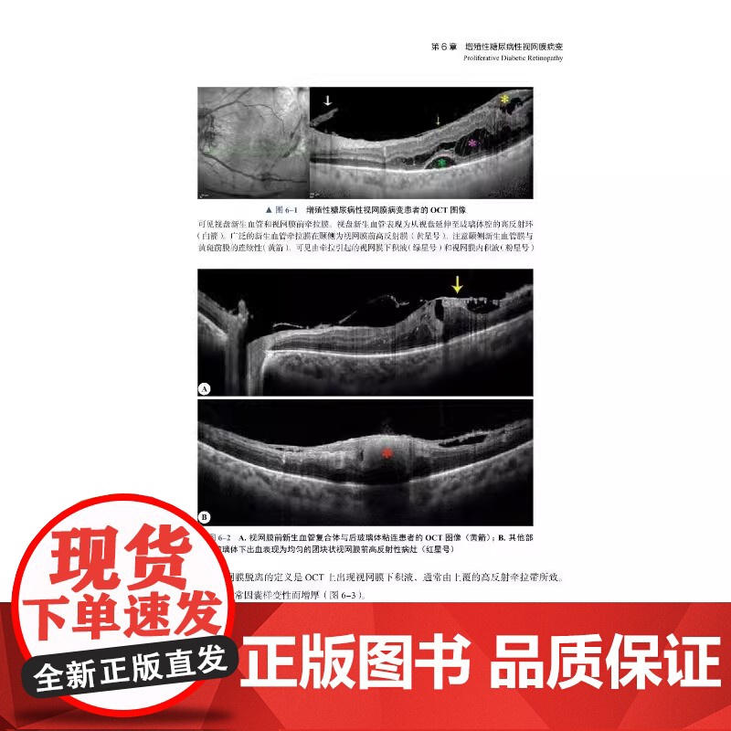 [央视网]眼底病OCT与OCTA 以言简意赅的表达形式对不同眼底疾病的影像特征进行细致描述 并配有丰富的图片资料ZK高清大图