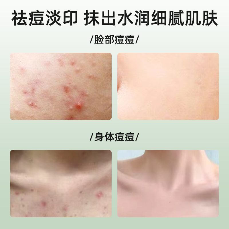 北京同仁堂草本植萃祛痘膏去学生青春痘改善油痘肌护修保湿女男士通用高清大图