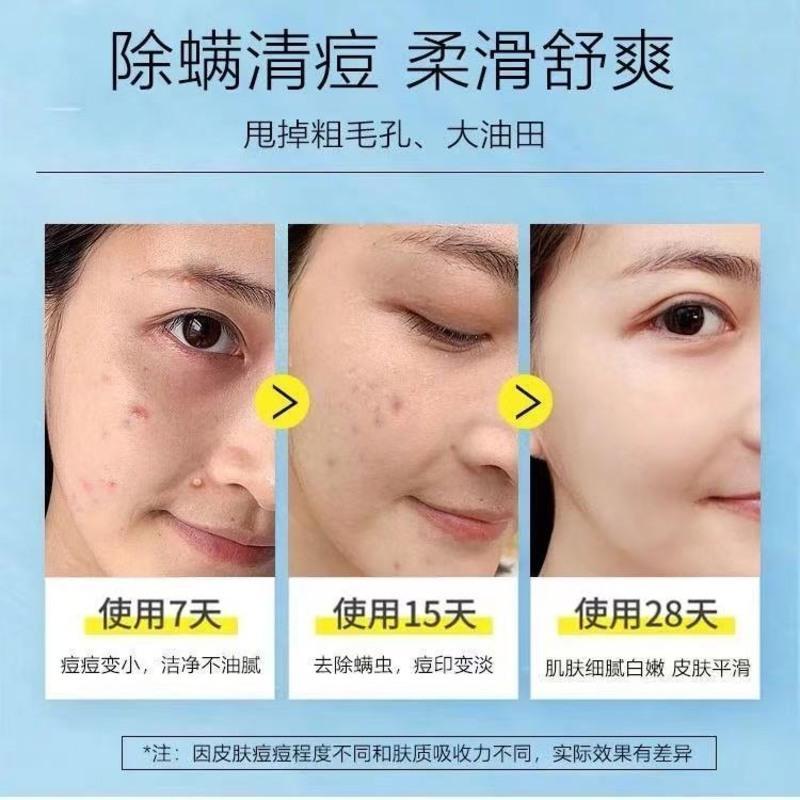 &lt;李佳琦推荐&gt;祛痘膏去痘印粉刺痘印修复男女学生祛痘疤痘坑去痘膏 一瓶装[轻度试用]