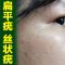 1盒体验装 去除脸部扁平疣丝状疣脖子手脚肉刺瘊子跖疣私处疣腋下身上寻常疣