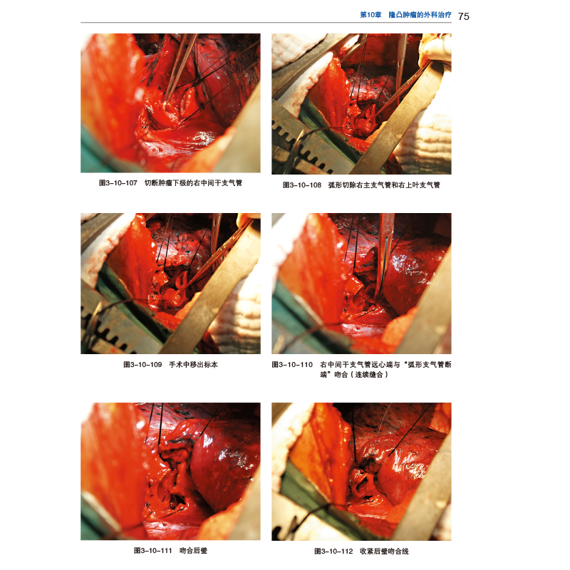 [正版]疑难胸部肿瘤手术学 许林 张勤9787571307172高清大图
