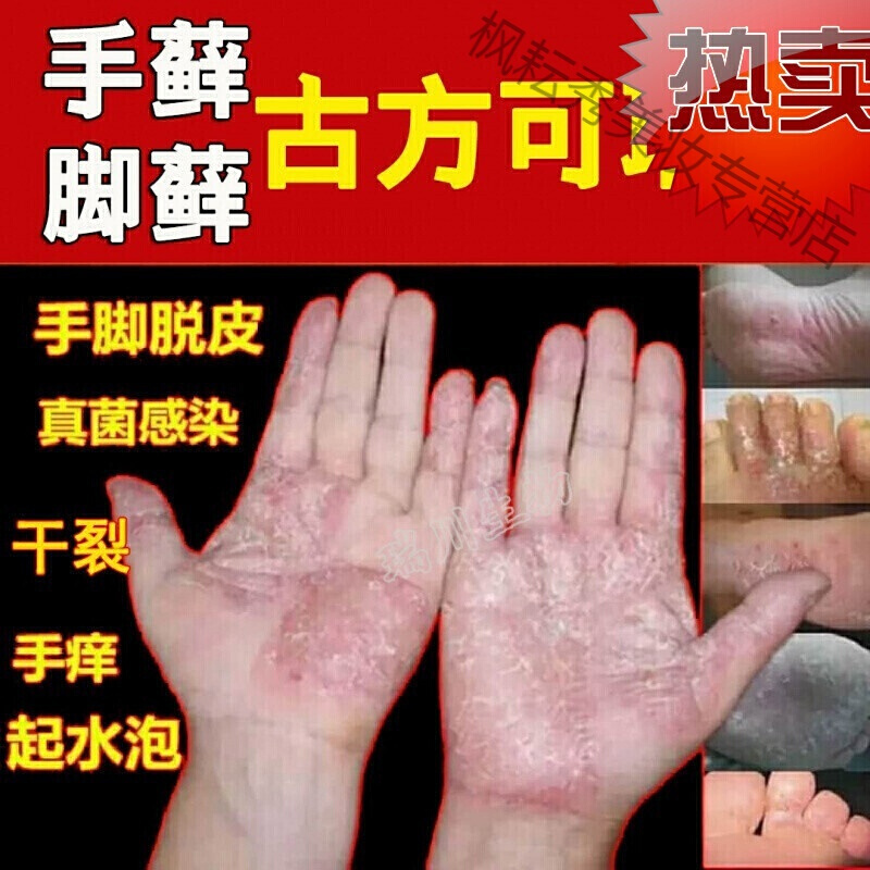 治的疗汗疱疹疱手藓的膏湿的疹鹅掌风手癣膏手足癣真的菌感染脱皮水泡