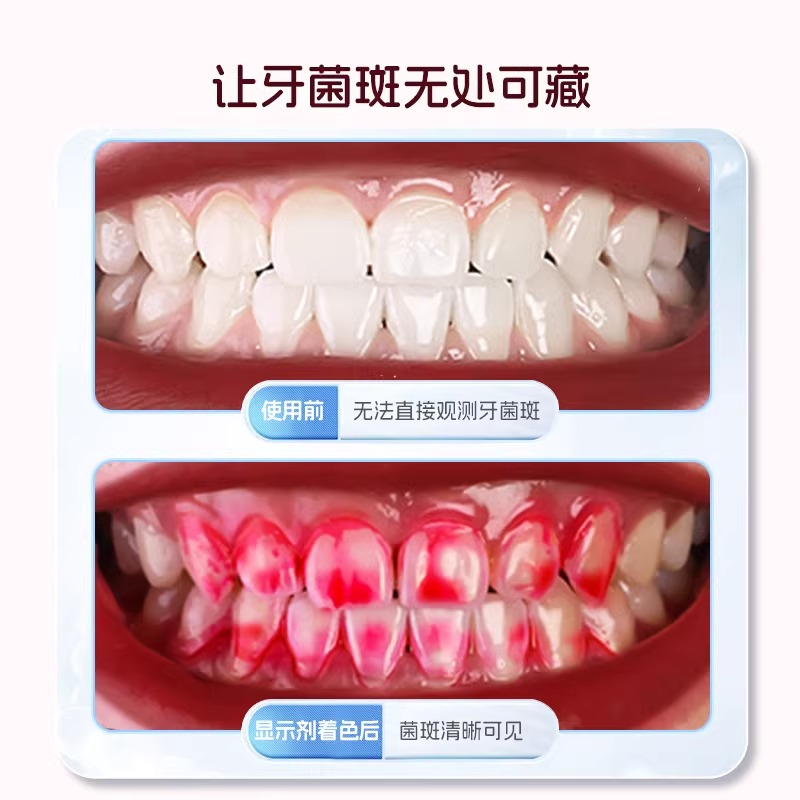 优利特医用牙菌斑显示剂指示剂儿童成人口腔牙齿牙垢祛除显色剂漱口液高清大图