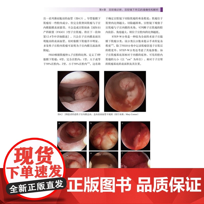 宫腔镜的诊断及手术技巧 子宫疾病 内窥镜检 妇科外科手术 北京科学技术高清大图