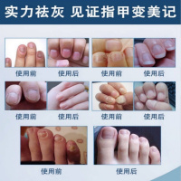 灰呷一号贝芙迪草本抑菌凝胶灰指甲凸凹甲烂甲软甲膏养甲