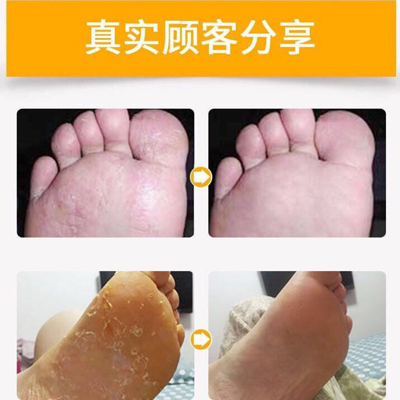 【老中医秘方】3-7天去脚气膏蚊子叮咬止痒草本白色乳膏偏方