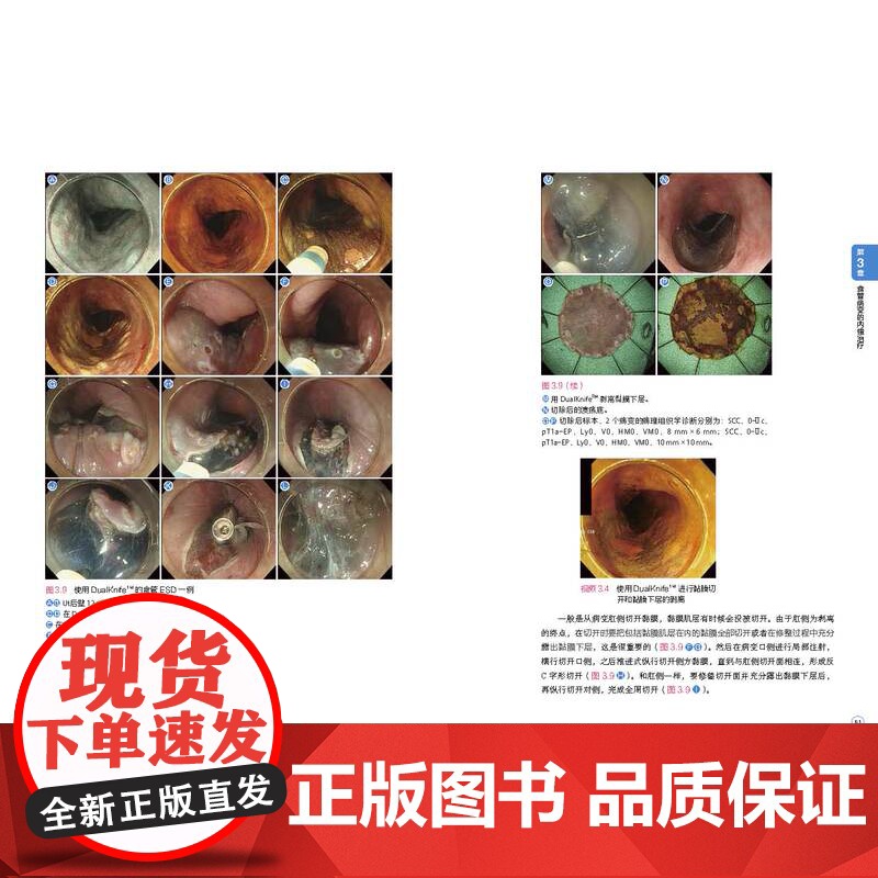 食管胃十二指肠ESD 操作诊断和治疗基础与技巧 ESD 内镜黏膜下剥离术 消化内镜 北京科学技术高清大图
