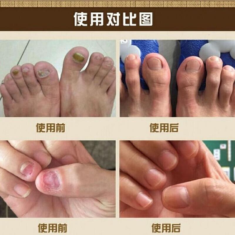 严尔康灰甲灵灰指甲专用甲指生源膏国西甲本灵西林严尔康灰甲灵