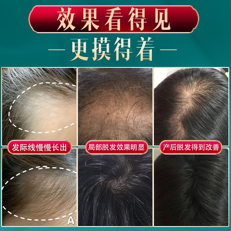 仁和(RENHE) 防脱育发液生发增发密发头发增长液男女生发液神器头皮营养液 100ml/瓶