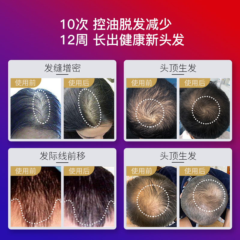 可思美 CosBeauty LLLT黑科技激光生发仪 生发帽密发神器10次控油12周健发新生81束激光灯男女适用