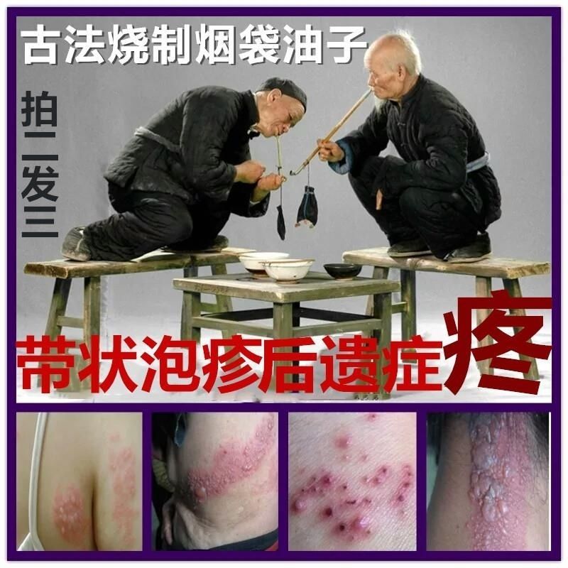 老烟袋油子蛇盘疮蛇胆疮腰缠龙腰缠蛇后遗症旱玳箕
