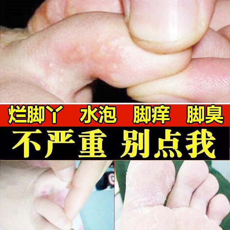 脚气膏喷雾去除脚臭脚痒烂脚丫水泡脱皮脚汗克星狼毒[喷剂 软膏]套装>