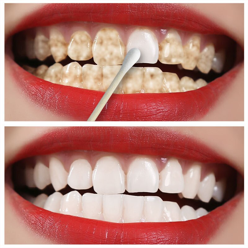 牙去除牙齿速效去牙烟芽秀牙斑净牙垢黑渍洗牙粉液牙贴牙膏洗牙水